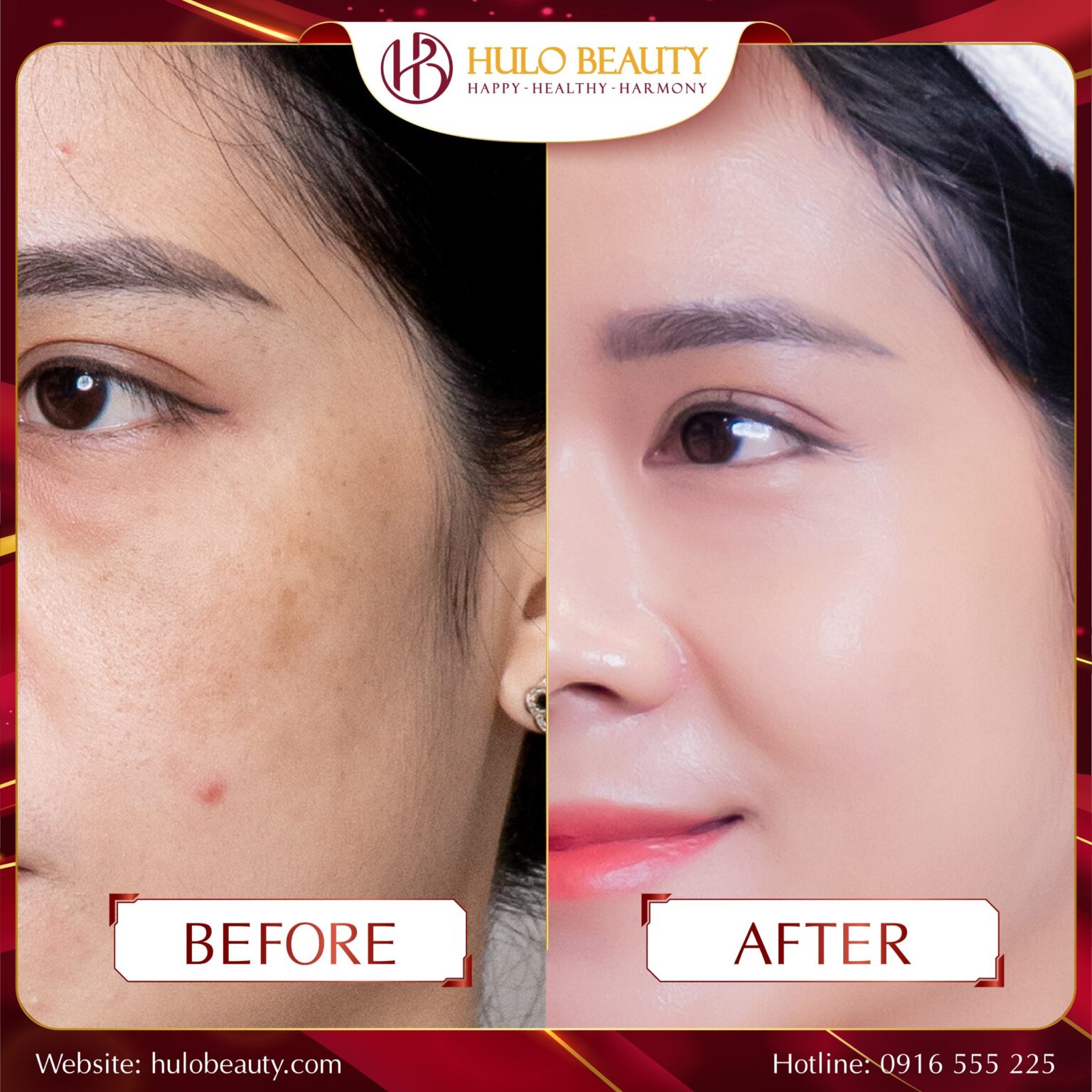 Hình ảnh của khách hàng sau liệu trình Medilasma