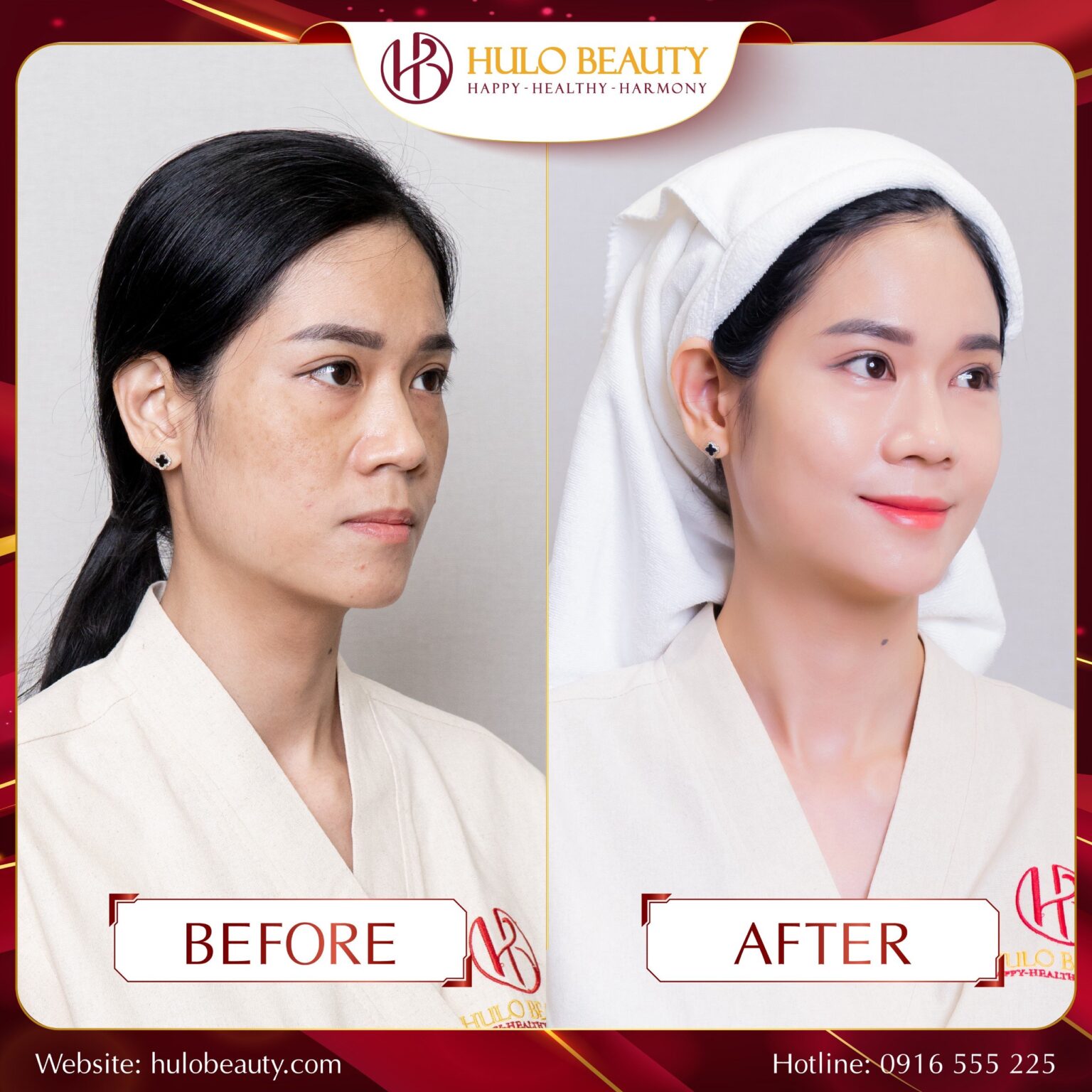 Loại bỏ đến 90% nám sau liệu trình