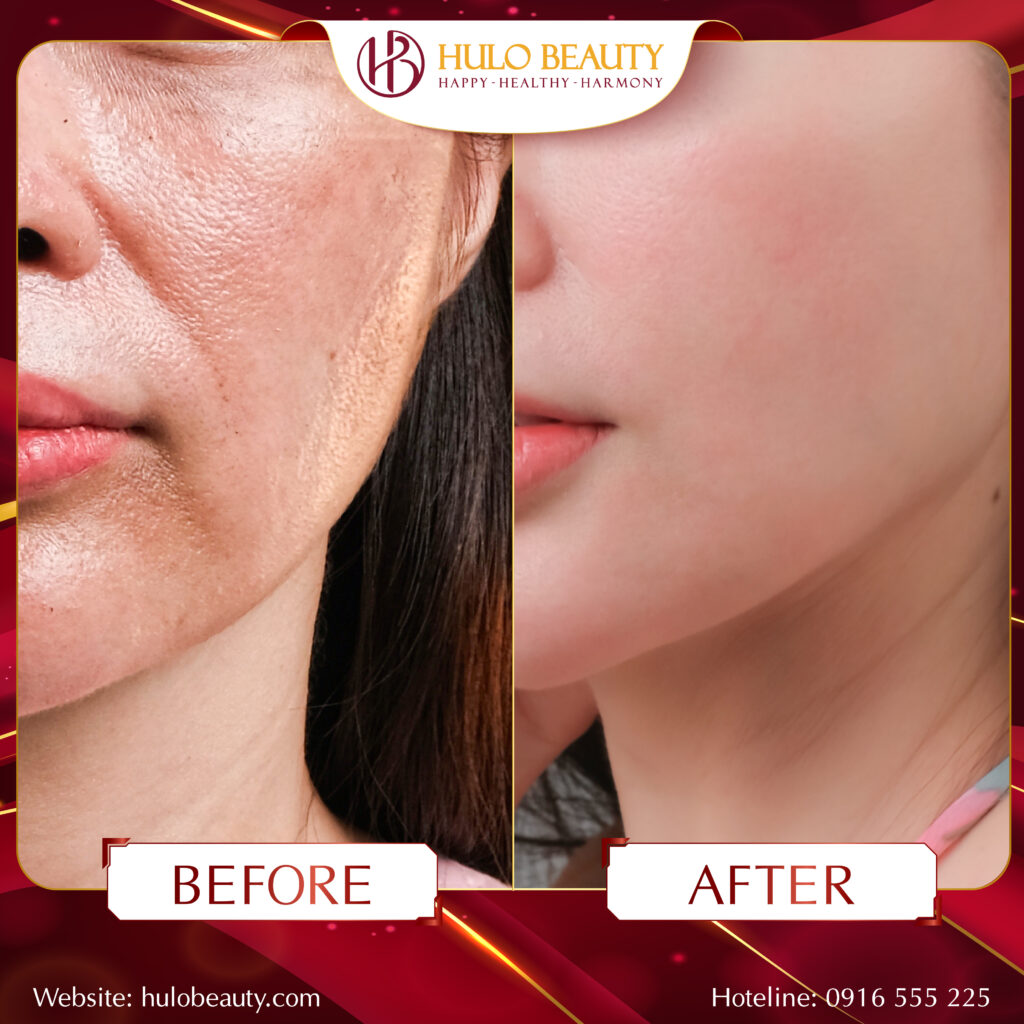 Khách hàng cảm thấy hài lòng sau khi trải nghiệm dịch vụ Light Peel QPlus