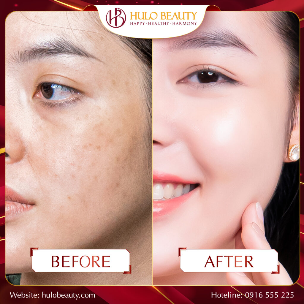 Làn da trắng sáng và rạng rỡ của khách hàng sau liệu trình