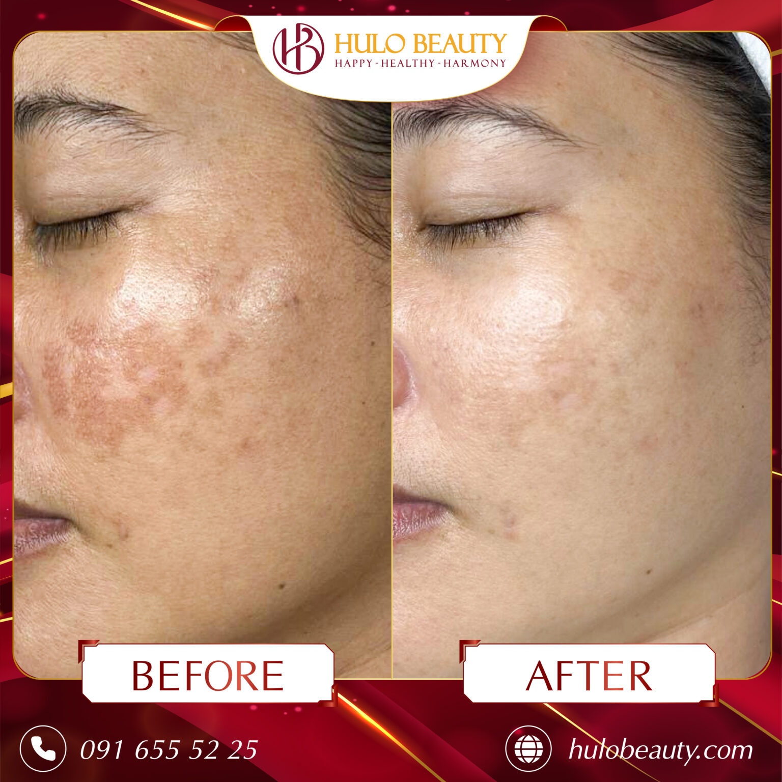 Hình ảnh của khách hàng sau liệu trình Medilasma