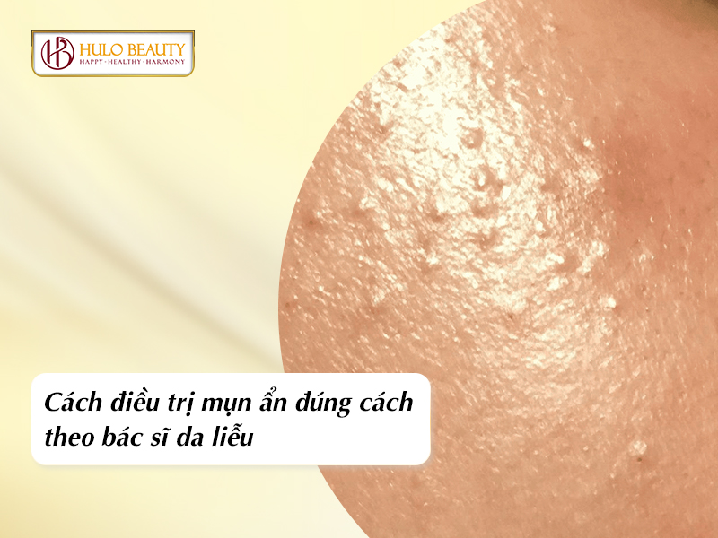 điều trị mụn ẩn