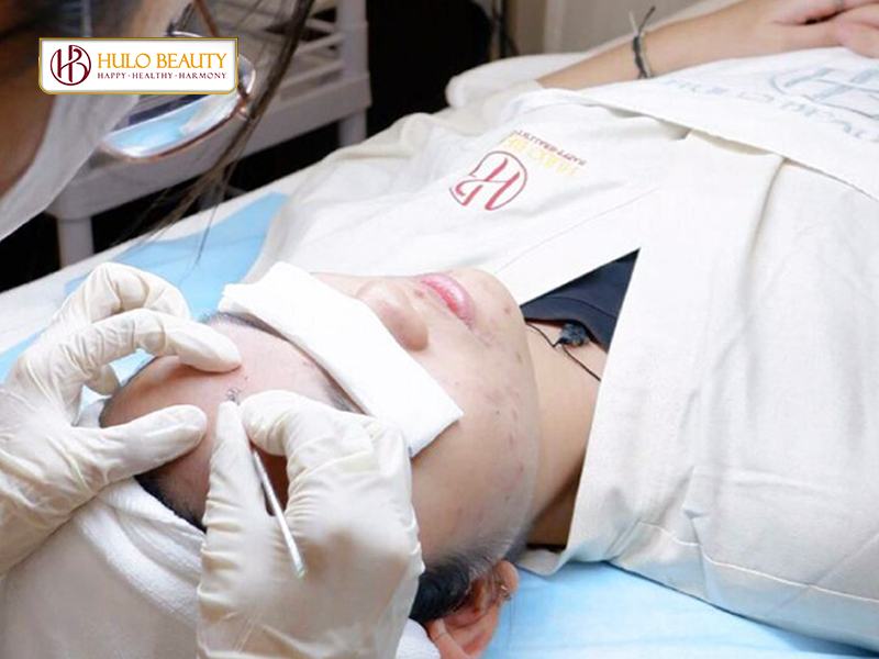 Bước 3: Lấy nhân mụn