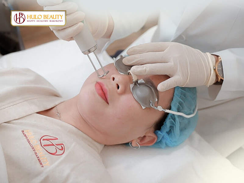 Bước 4: Loại bỏ hắc sắc tố với laser Châu Âu
