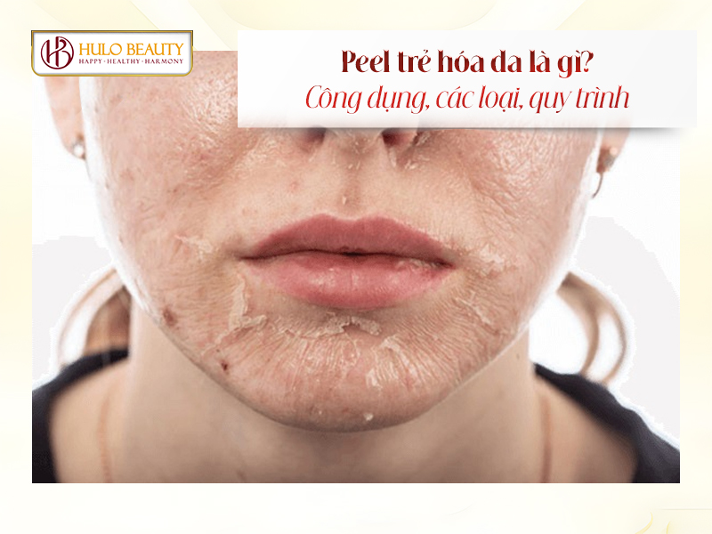 peel trẻ hóa da
