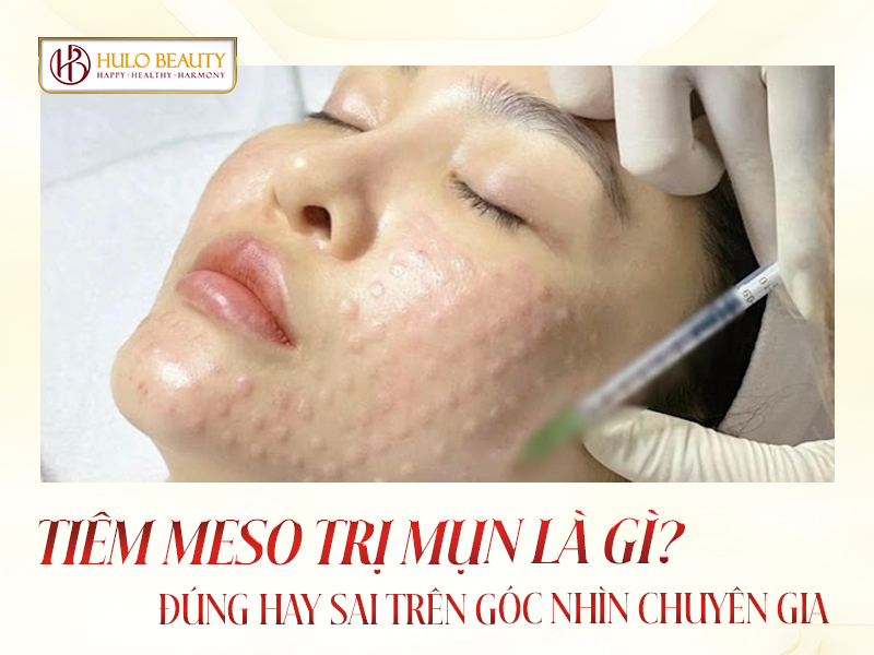 meso trị mụn